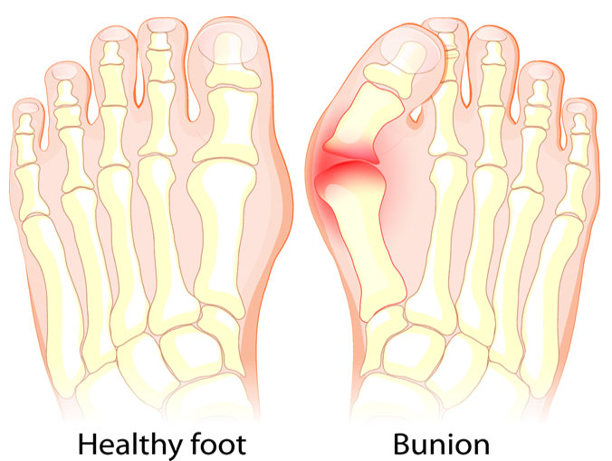 best shoes for wide feet with bunions